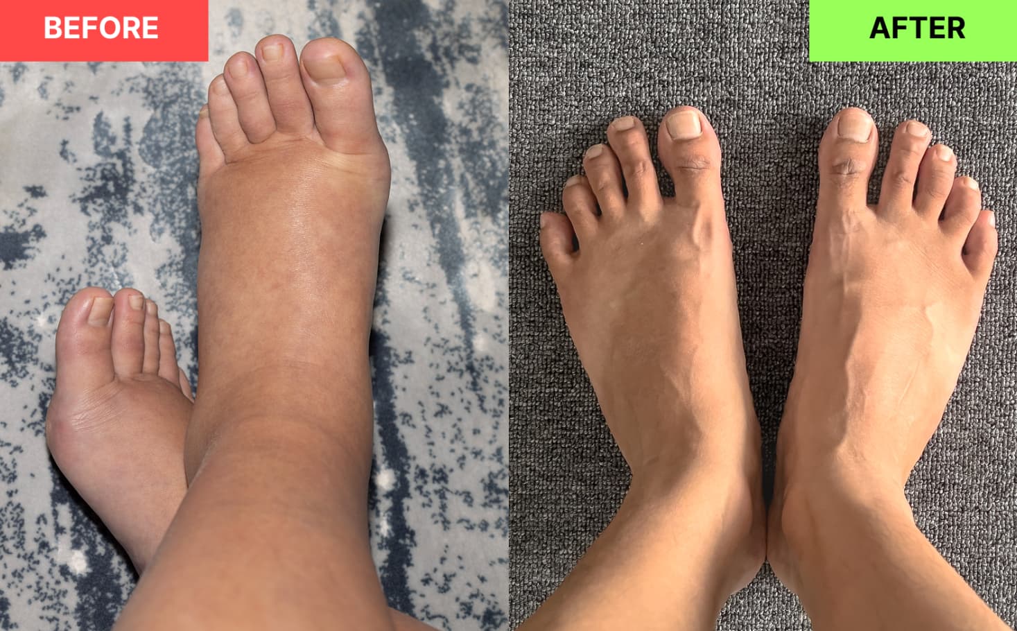 BEFORE: Swollen, puffy foot and ankle